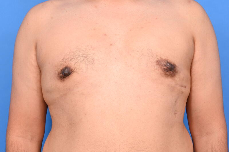 Gynecomastia Surgery Before & After Image