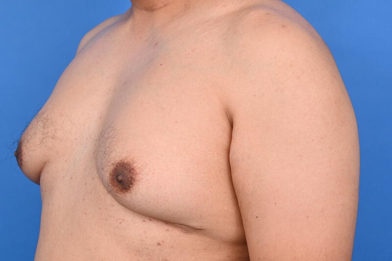 Gynecomastia Surgery Before & After Image