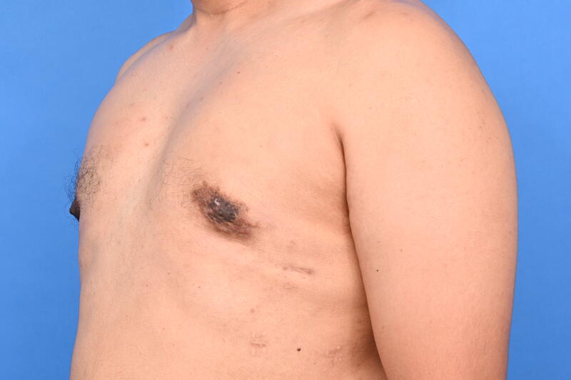 Gynecomastia Surgery Before & After Image