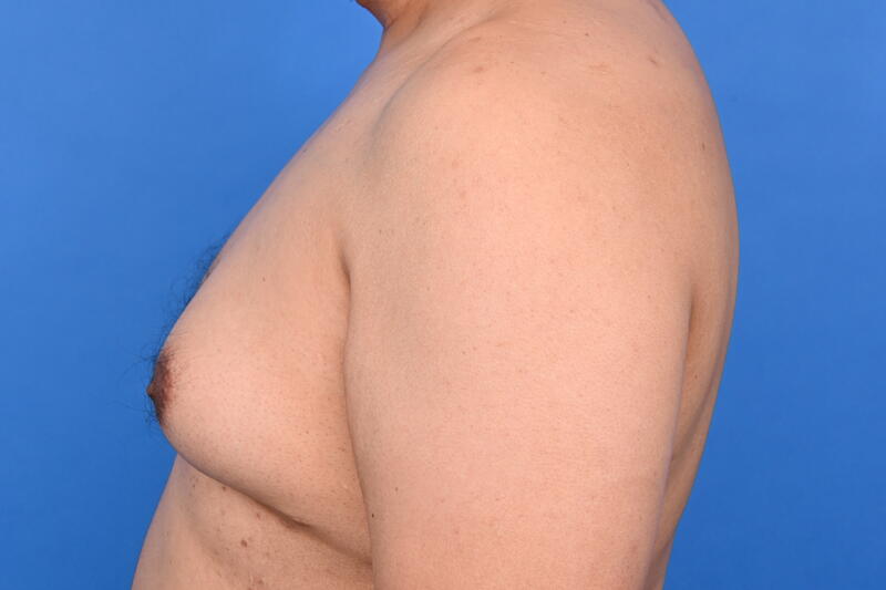 Gynecomastia Surgery Before & After Image