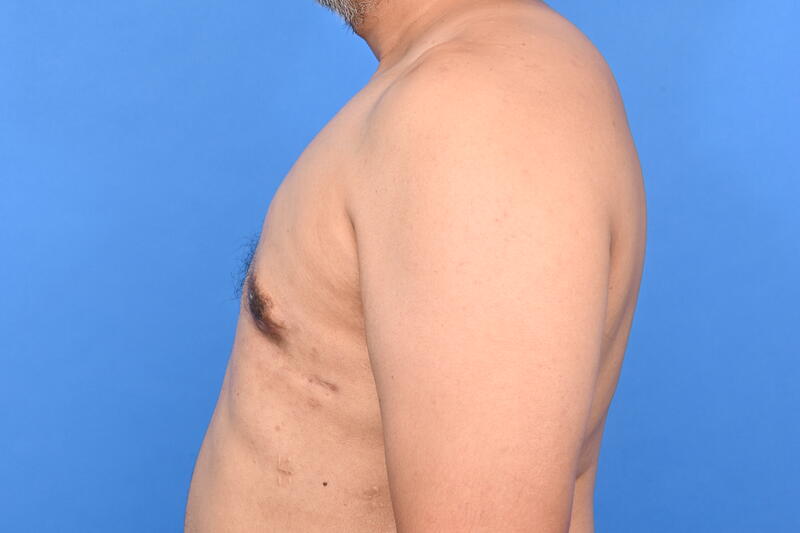 Gynecomastia Surgery Before & After Image