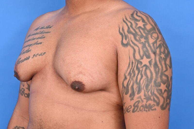 Gynecomastia Surgery Before & After Image