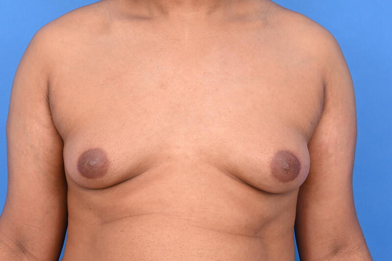 Gynecomastia Surgery Before & After Image