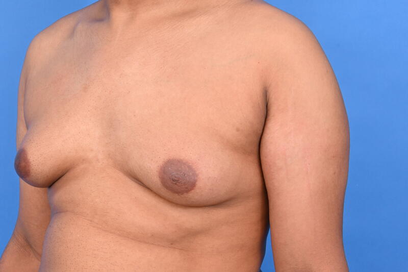 Gynecomastia Surgery Before & After Image