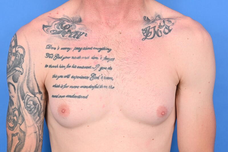 Gynecomastia Surgery Before & After Image