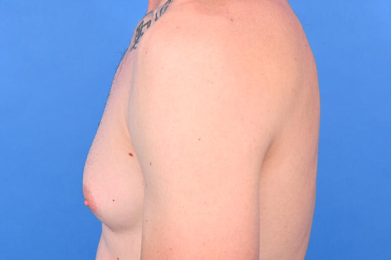 Gynecomastia Surgery Before & After Image