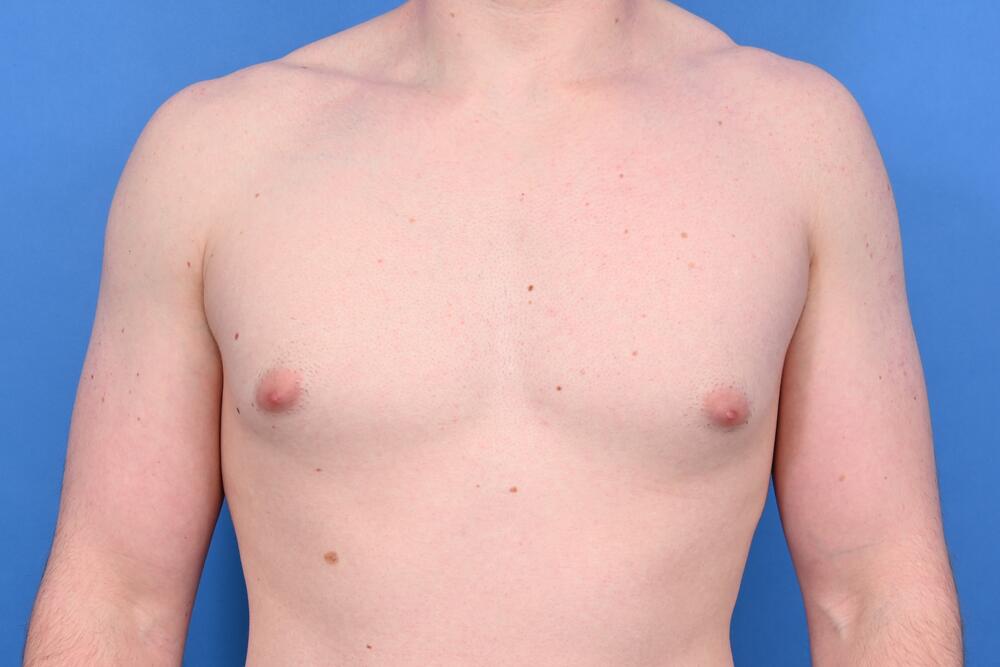 Gynecomastia Surgery Before & After Image