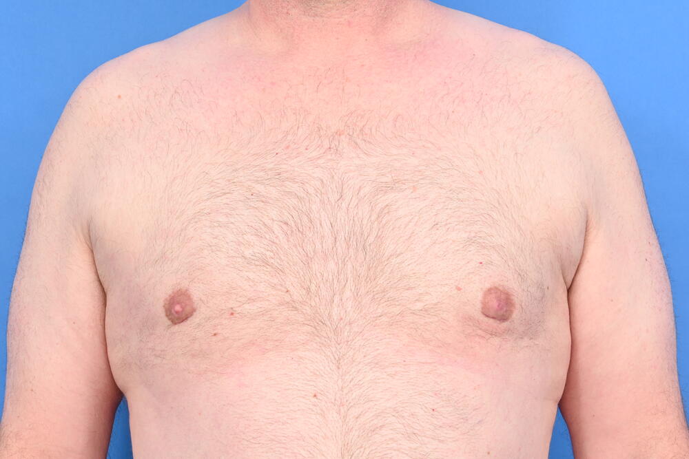 Gynecomastia Surgery Before & After Image