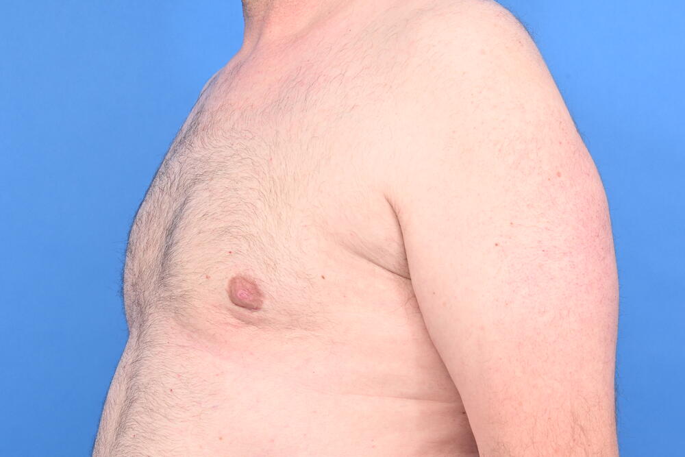 Gynecomastia Surgery Before & After Image