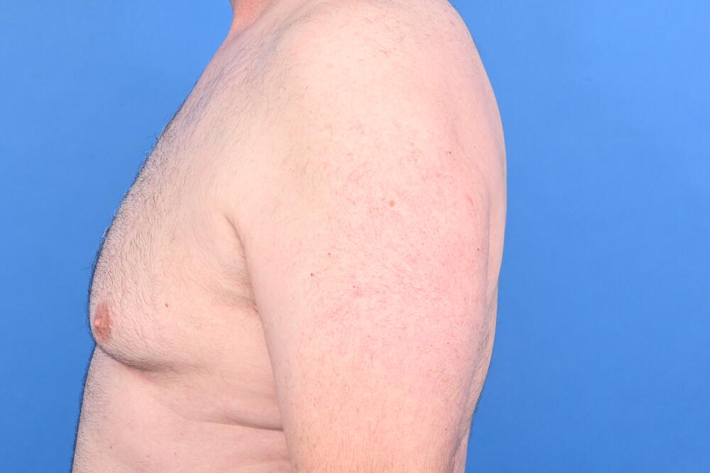 Gynecomastia Surgery Before & After Image