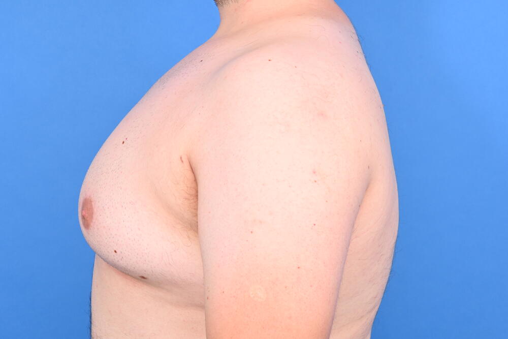 Gynecomastia Surgery Before & After Image