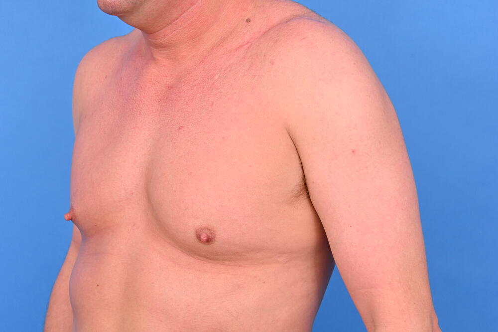 Gynecomastia Surgery Before & After Image