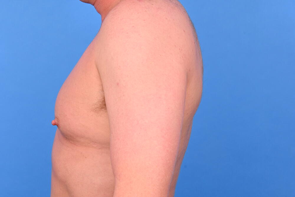 Gynecomastia Surgery Before & After Image