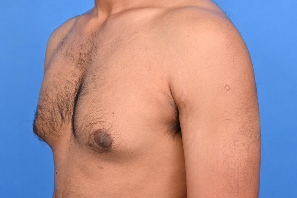 Gynecomastia Surgery Before & After Image