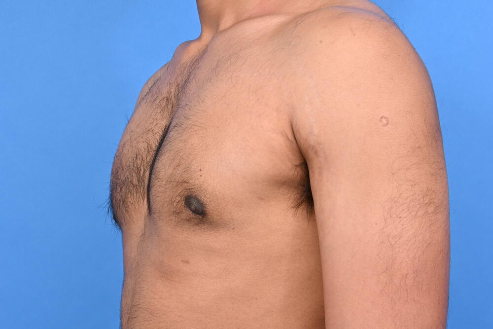 Gynecomastia Surgery Before & After Image