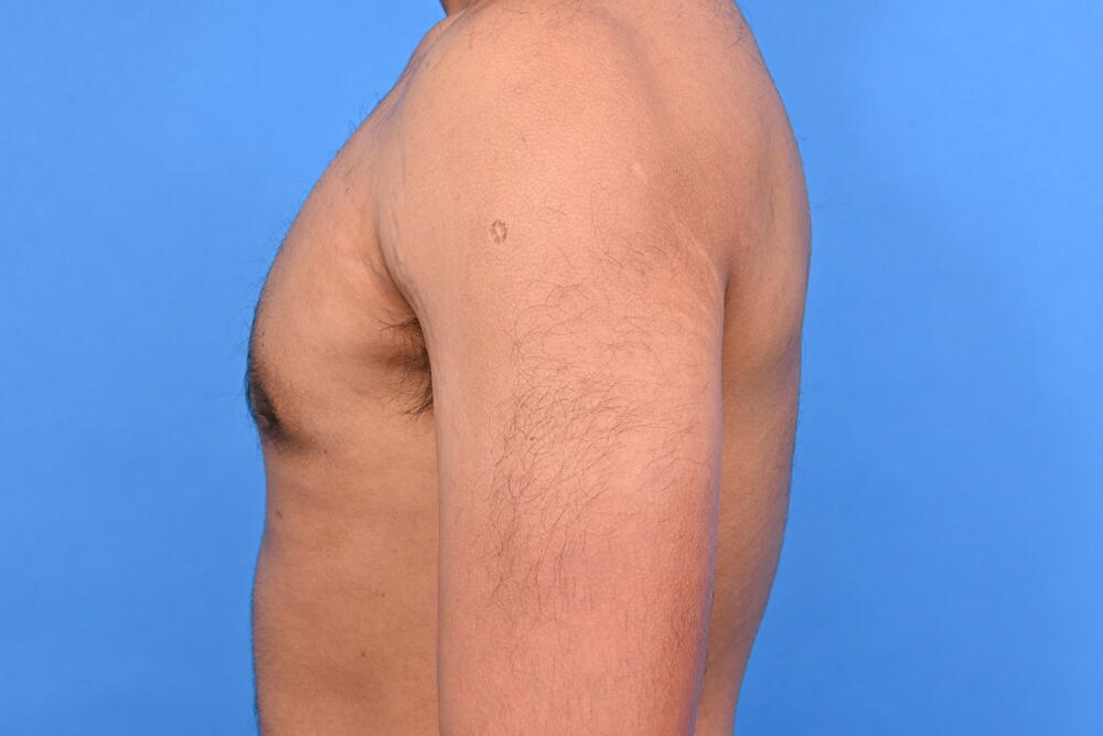 Gynecomastia Surgery Before & After Image