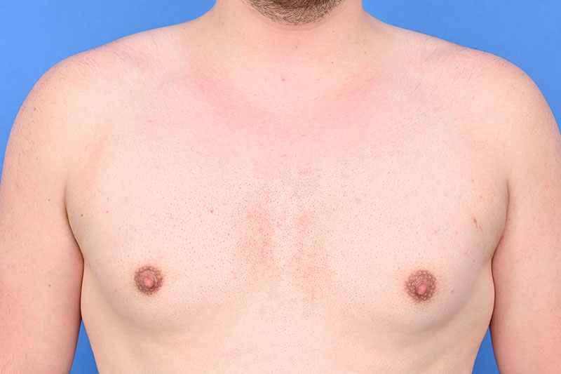 Gynecomastia Surgery Before & After Image