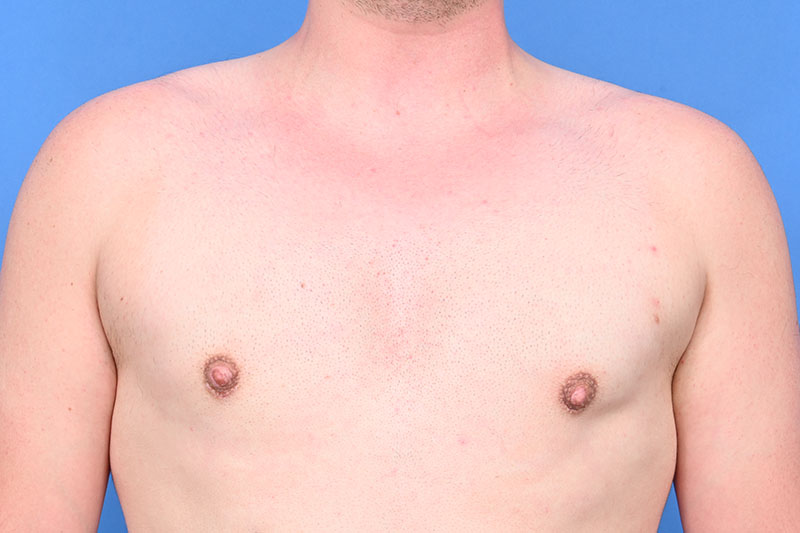Gynecomastia Surgery Before & After Image