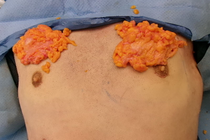 Gynecomastia Surgery Before & After Image