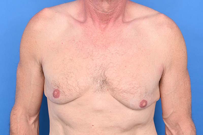 Gynecomastia Surgery Before & After Image