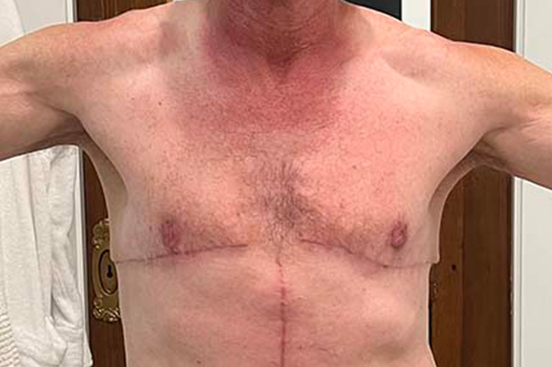 Gynecomastia Surgery Before & After Image