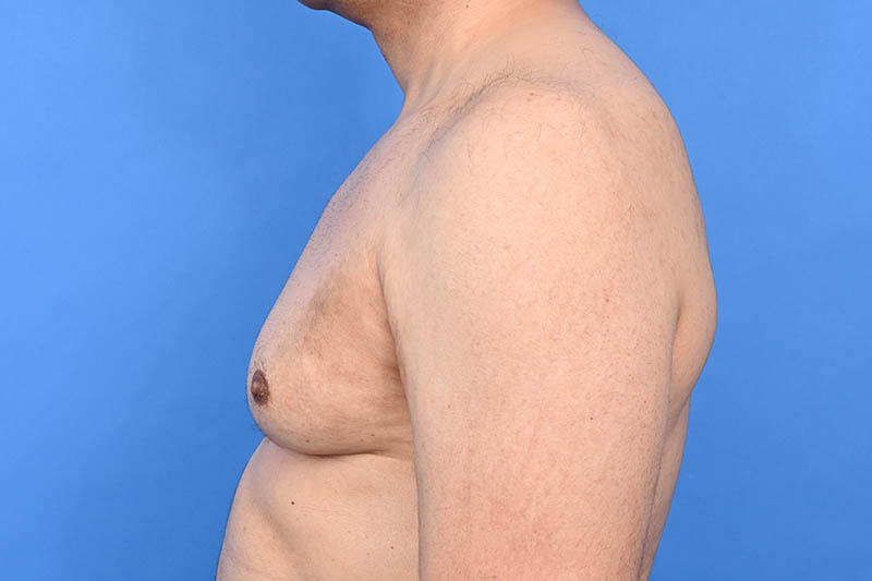 Gynecomastia Surgery Before & After Image