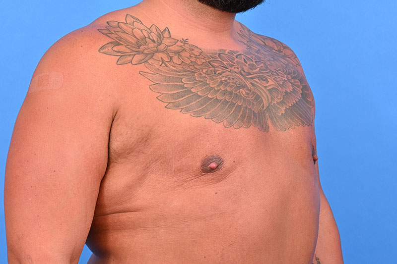 Gynecomastia Surgery Before & After Image