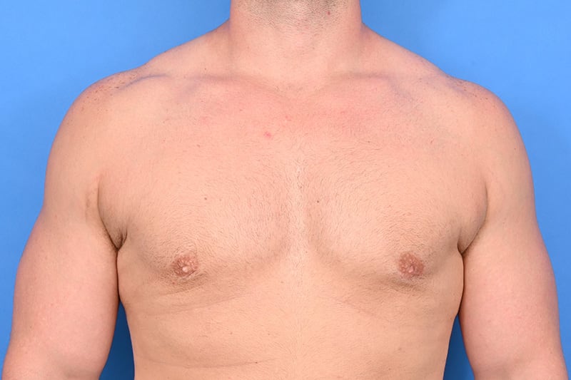 Gynecomastia Surgery Before & After Image