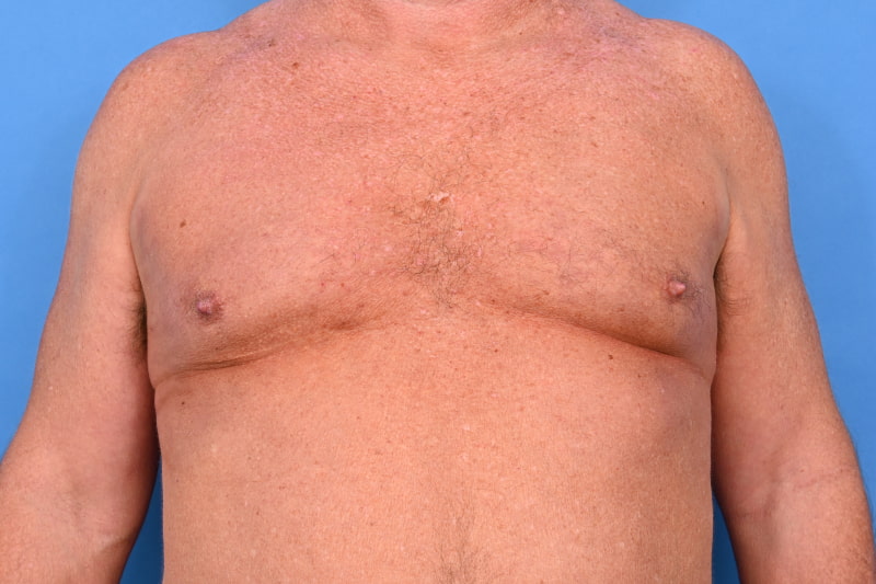 Gynecomastia Surgery Before & After Image