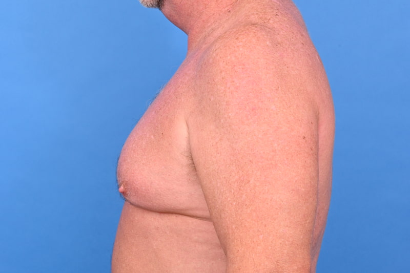 Gynecomastia Surgery Before & After Image