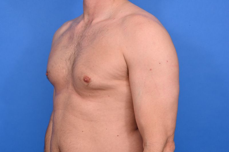Gynecomastia Surgery Before & After Image