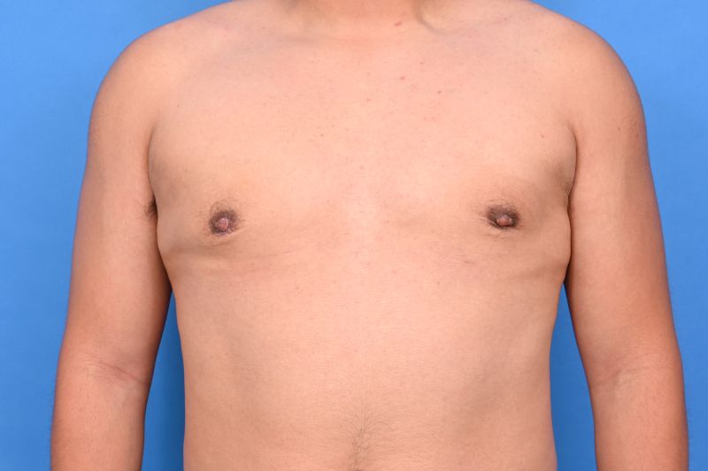 Gynecomastia Surgery Before & After Image