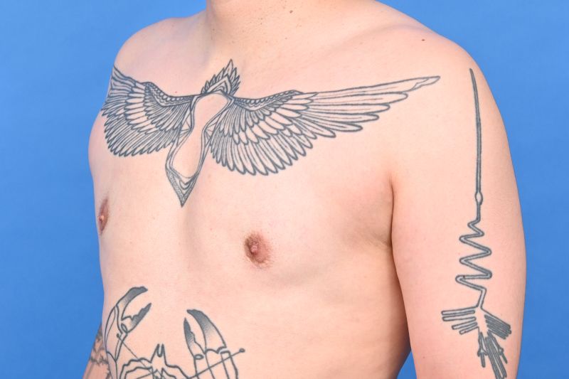 Gynecomastia Surgery Before & After Image