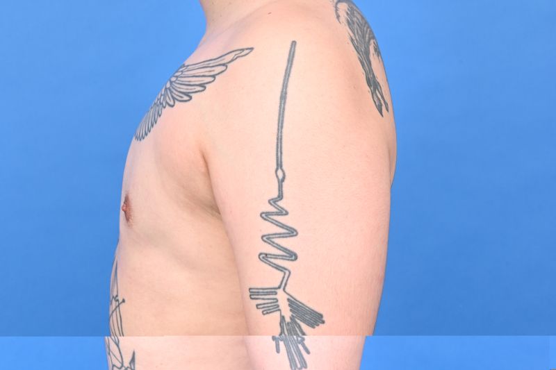 Gynecomastia Surgery Before & After Image