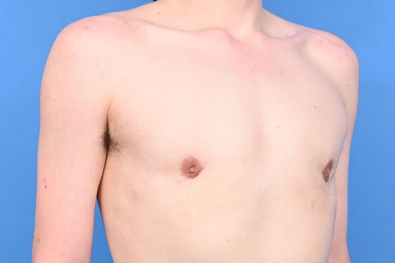 Gynecomastia Surgery Before & After Image