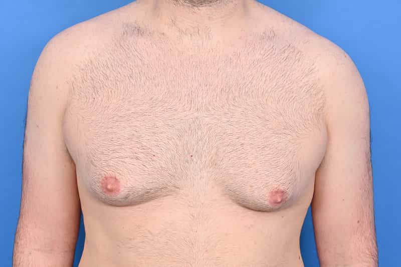 Gynecomastia Surgery Before & After Image