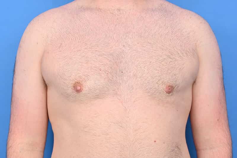 Gynecomastia Surgery Before & After Image