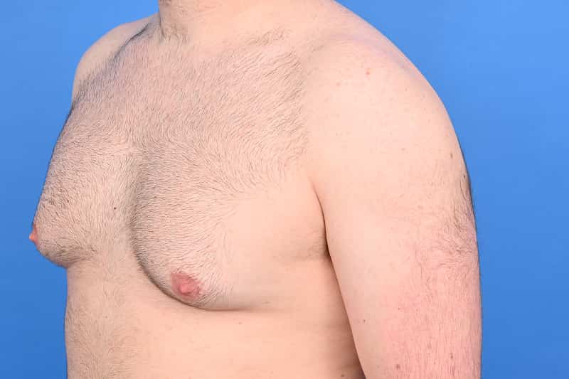 Gynecomastia Surgery Before & After Image