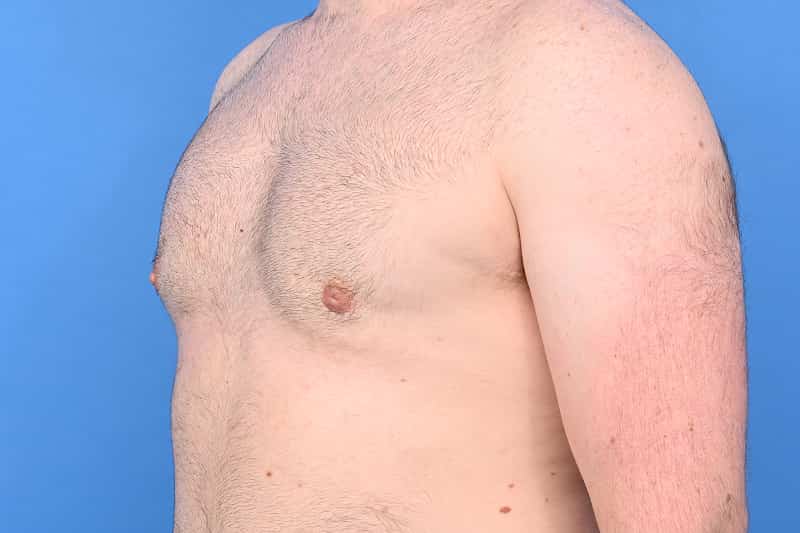 Gynecomastia Surgery Before & After Image