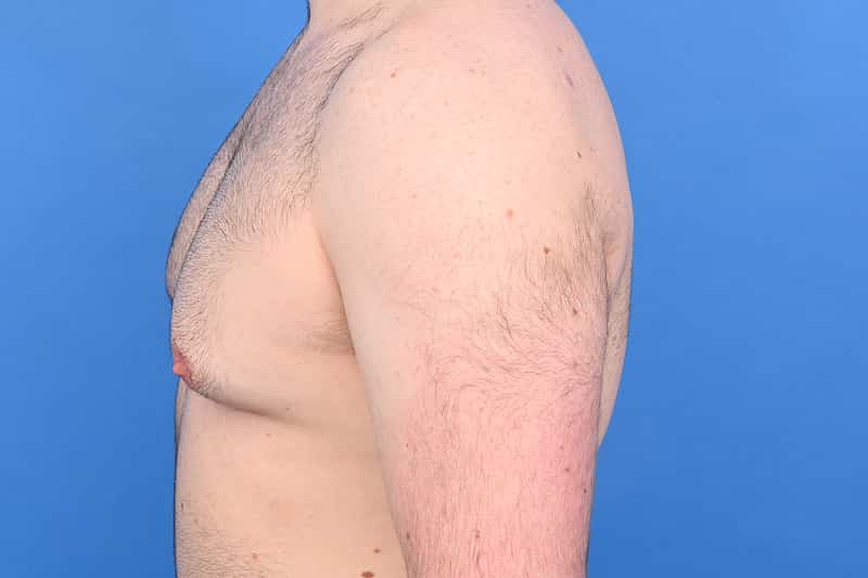 Gynecomastia Surgery Before & After Image