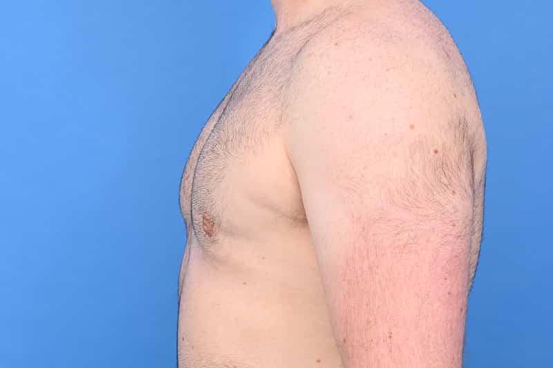 Gynecomastia Surgery Before & After Image