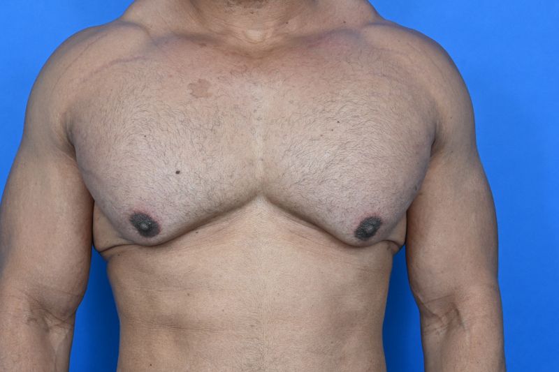 Gynecomastia Surgery Before & After Image