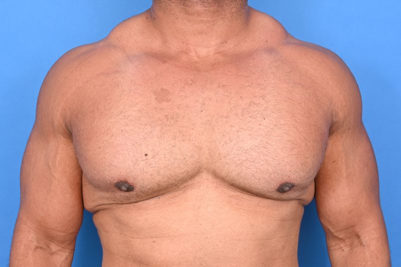 Gynecomastia Surgery Before & After Image