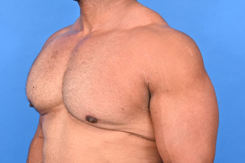 Gynecomastia Surgery Before & After Image