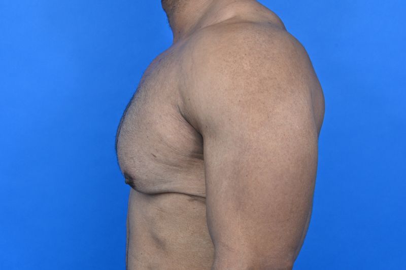 Gynecomastia Surgery Before & After Image