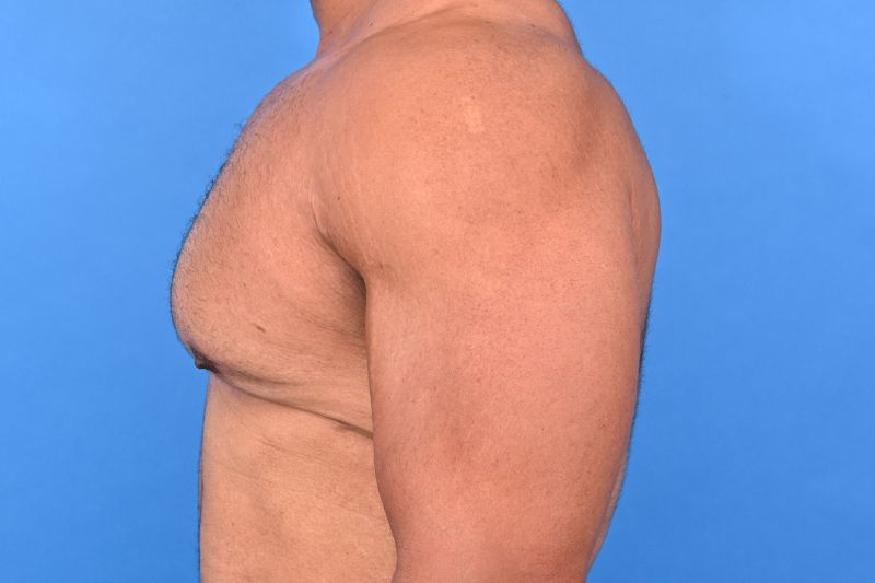 Gynecomastia Surgery Before & After Image