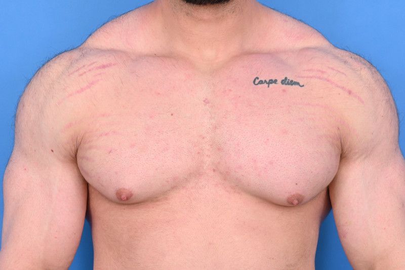 Gynecomastia Surgery Before & After Image