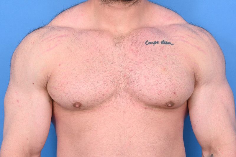 Gynecomastia Surgery Before & After Image