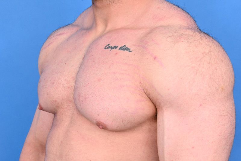 Gynecomastia Surgery Before & After Image