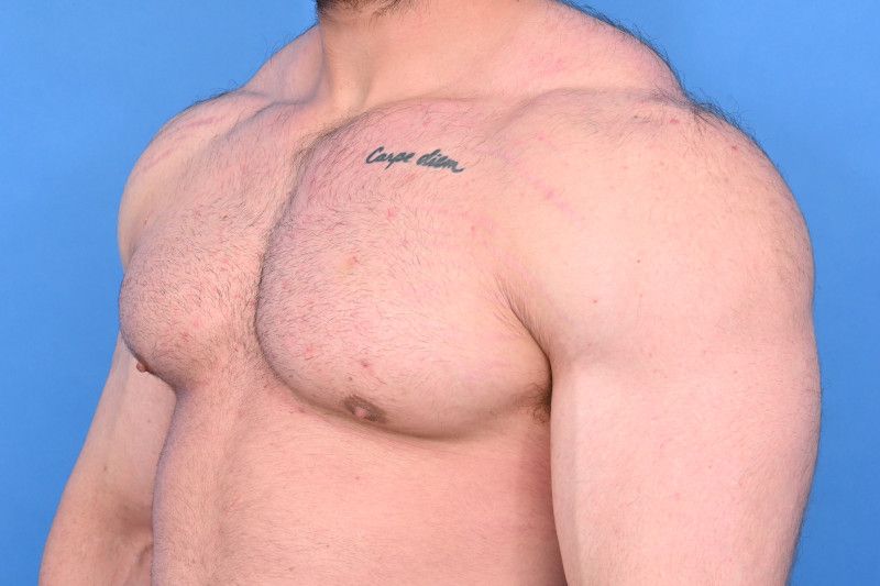 Gynecomastia Surgery Before & After Image